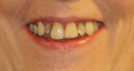 teeth before