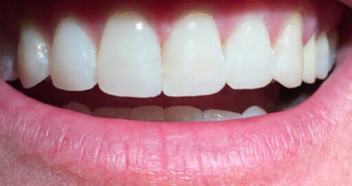 teeth after